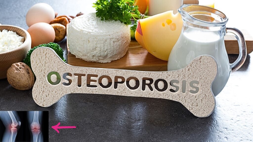 osteoporosis